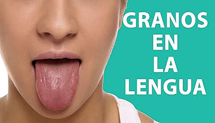 Cuál es la causa de los granos en lengua y garganta
