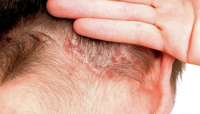 Teñir el cabello con psoriasis