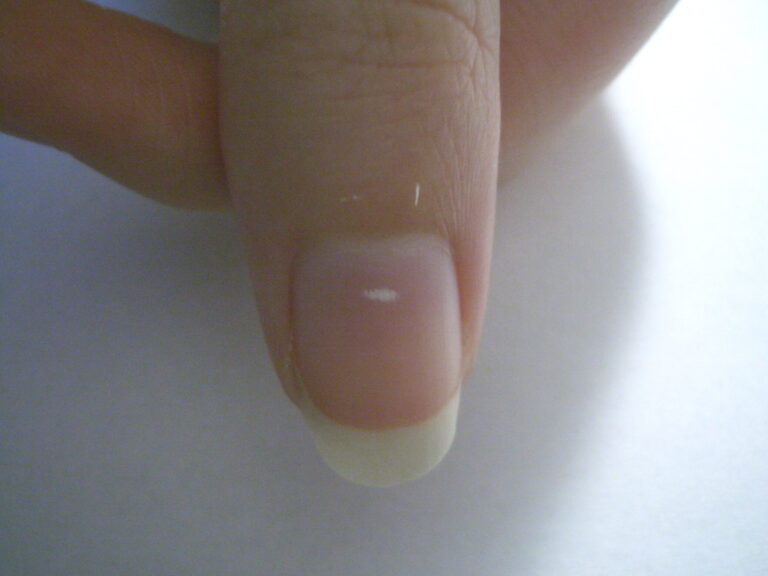 Manchas Blancas en las Uñas: ¿Qué se Esconde tras ellas?