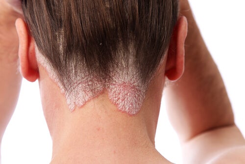 Teñirse el pelo con psoriasis: ¿es posible o un riesgo para la piel?