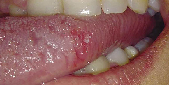 Lo que debes saber del VPH y granos en la lengua